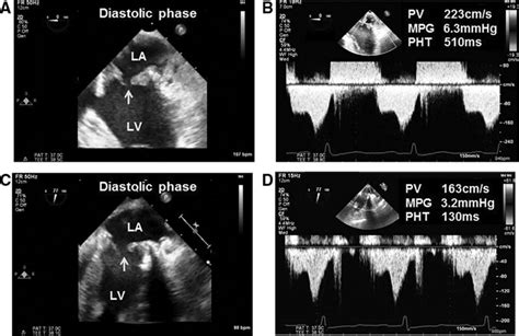 Two Cases Of Acute Bioprosthetic Mitral Valve Thrombosis Immediately