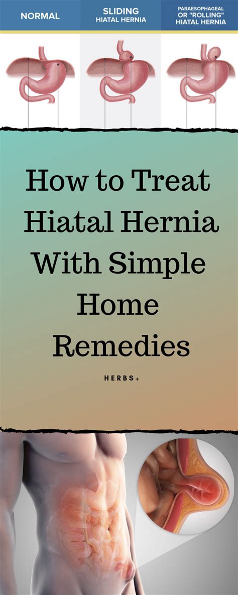How To Treat Hiatal Hernia With Simple Home Remedies Natural Treatments Remedies Hiatal