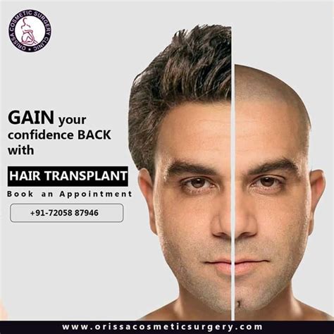 For Many People A Hair Transplant Can Help Bring Back The Lost
