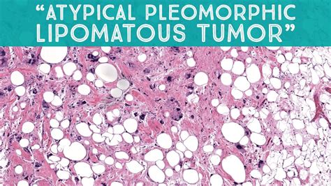 Atypical Pleomorphic Lipomatous Tumor Mimic Of Liposarcoma Aip