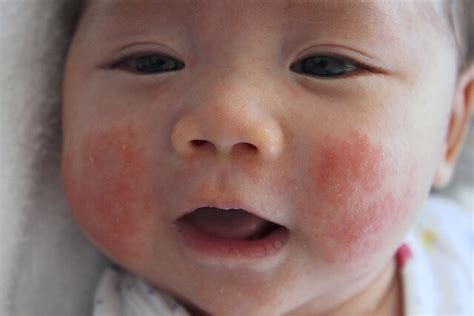 Infant Eczema Mummysg