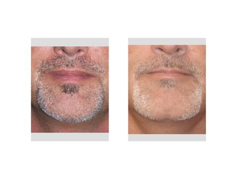 Blog Archivetechnical Strategies Square Chin Implant And Vertical