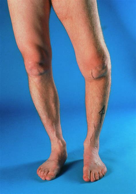Severe Osteoarthritis In The Left Knee Photograph By Medical Photo Nhs