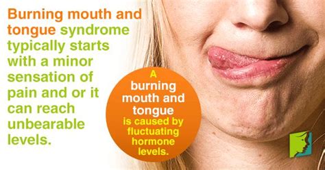 Burning Mouth And Tongue Burning Tongue Syndrome Sore Mouth And