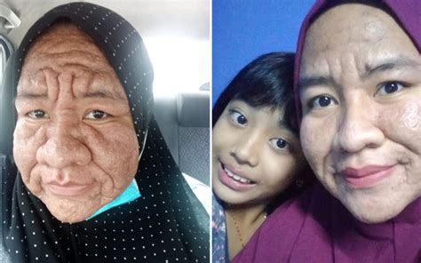 Msian Woman Shares How Her Face Became Swollen And Heavily Wrinkled