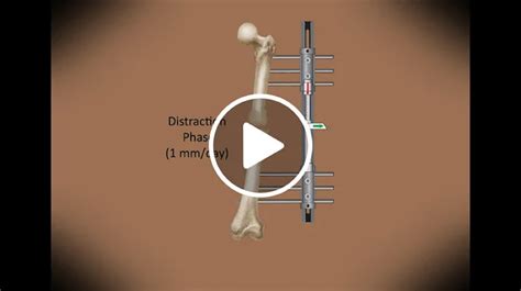 Osteotomy International Center For Limb Lengthening