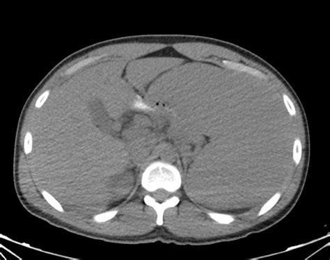 Marked Splenomegaly In A Patient With Lymphoma And Incidental Bladder
