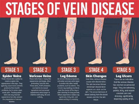 What Is Peripheral Venous Disease Symptoms Pelajaran