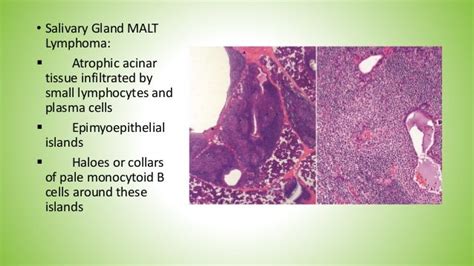 Diagnosis And Treatment Of Gi Malt Lymphoma