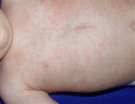 Roseola Treatment Pictures Photos