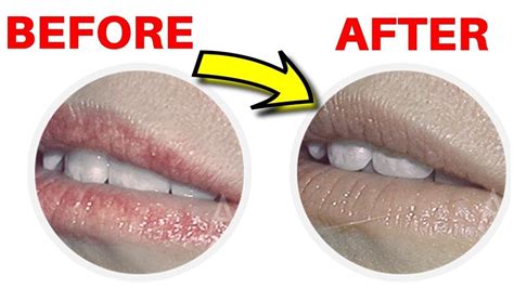 How To Get Rid Of Fordyce Spots On Lips Naturally At Home Little