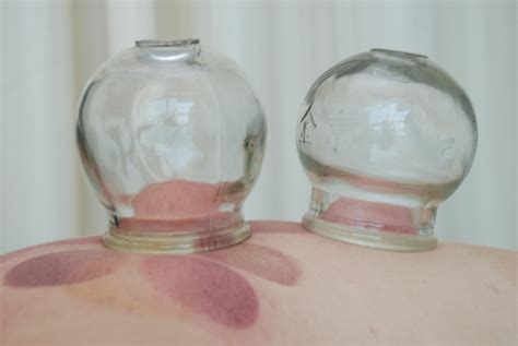 Cupping Therapy Dr Xie In Lake County Libertyville Dr Xies Lake