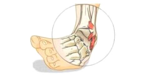 Anatomy Ligament Ankle Sprain