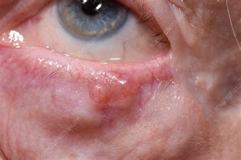 Basal Cell Carcinoma Of The Eye Stock Image C0345472 Science