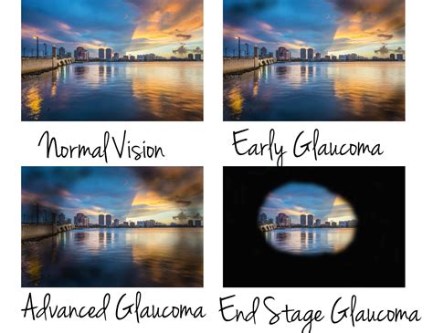 Glaucoma Grace And Vision Optometrist Brisbane