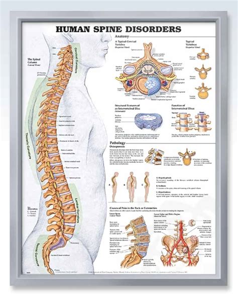 Human Spine Disorders Exam Room Anatomy Poster Clinicalposters