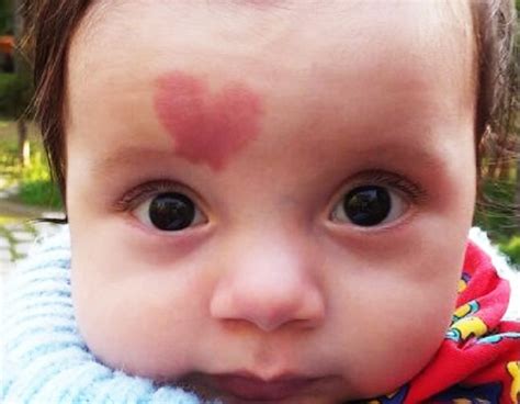 Baby Born With ‘heart Birthmark Became World Famous In 2015