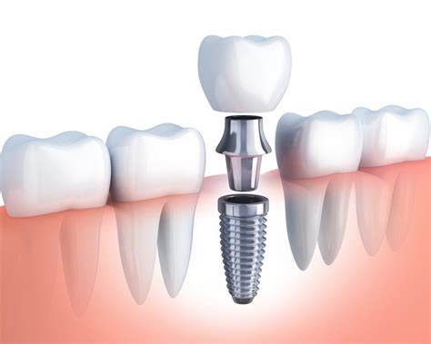 Dental Implant Procedure Everything You Need To Know