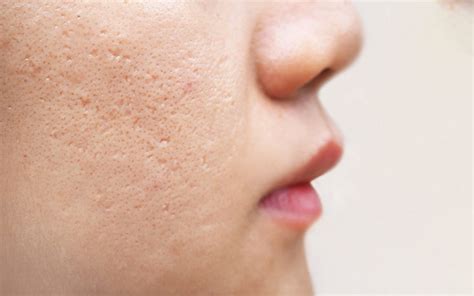 How To Treat Acne Scars With Ancient Ayurvedic Secrets Vedix