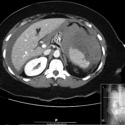 Ct Abdomen With Intravenous And Oral Contrast Free Perihepatic And