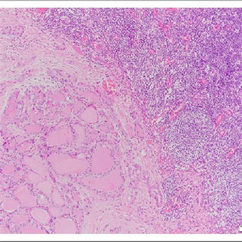Pdf Cervical Tuberculosis Combined With Papillary Thyroid Carcinoma