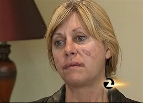 Wtf Woman Attempts Plastic Surgery On Her Own Face Straight From