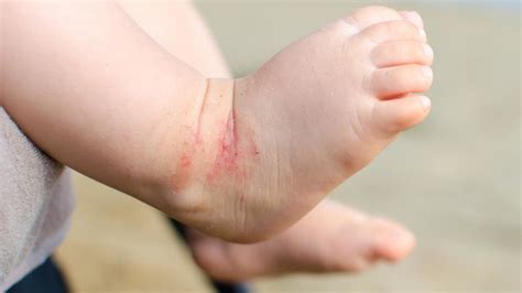 Eczema Symptoms Causes And Treatments From Yeast Food Allergy
