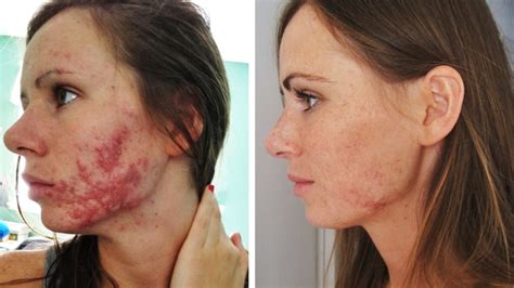 Accutane For Acne Treatment Zel Skin And Laser Specialists And Laser