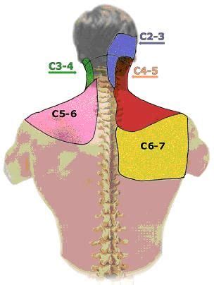 Cervical Facet Syndrome A Pain In The Neck Inspire Spine Problems