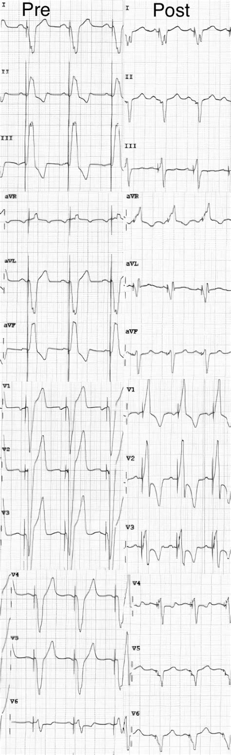 Twelve Lead ECG 25 Mm S Showing Sinus Rhythm And Left Bundle Branch