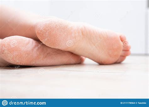 The Dry Skin On The Feet Is Cracked Treatment Concept With