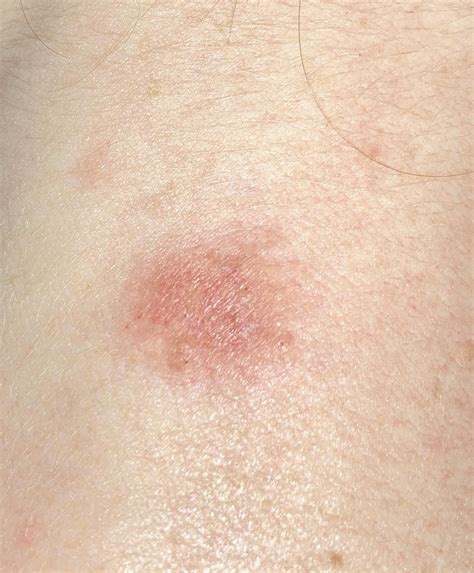 Help Isolated Red Slightly Bumpy Patches Of Skin Not Itchy Or