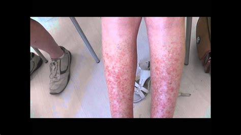 A Very Severe Case Of Sun Allergy Polymorphic Light Eruption Before