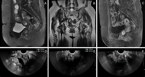 Frontiers Superficial Vaginal Myofibroblastoma With Mushroom Like