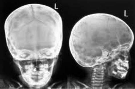 Ap skull landmarks6p image quiz. Ready to Use Therapeutic Food (RUTF) in the Management of ...