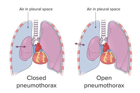 Pneumothorax Ursachen Symptome Und Behandlung Demedbo Vrogue Co