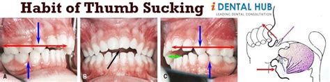 Habit Of Thumb Sucking Dental Assistant Dental Hygiene Dental Care