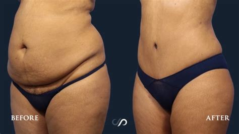 Mommy Makeover Tummy Tuck Lipo Before And After Dr David