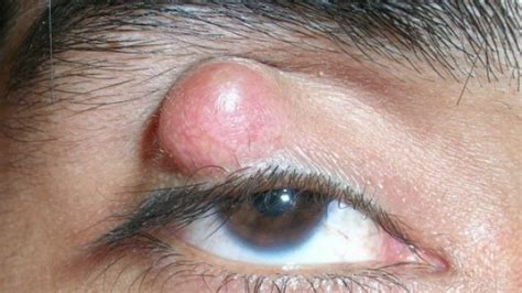 Eyelid Bumps Cornwall Premium Vision Surgical Centre