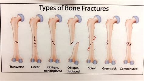 Broken Bones And Fractures