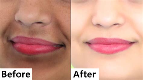 Remove Darkness Around Lips Dark Spots Hyper Pigmentation Around