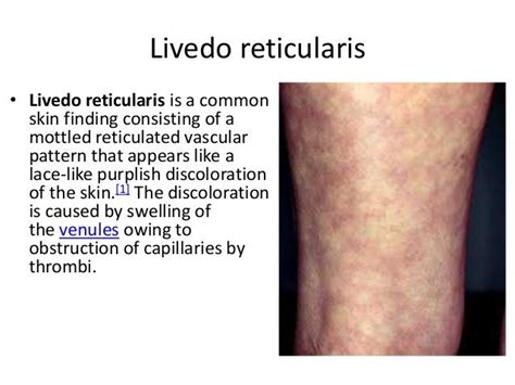 Livedo Reticularis Rimedi New Query