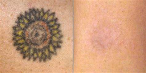 More images for remove tattoo naturally » Natural Tattoo Removal: How To Remove Tattoos Naturally?