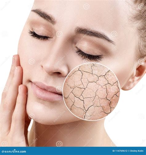 Zoom Circle Shows Dry Facial Skin Before Moistening Stock Photo