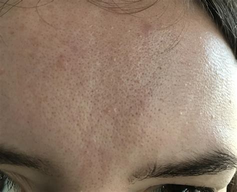 Orange Peel Skin Disaster W Pictures General Acne Discussion