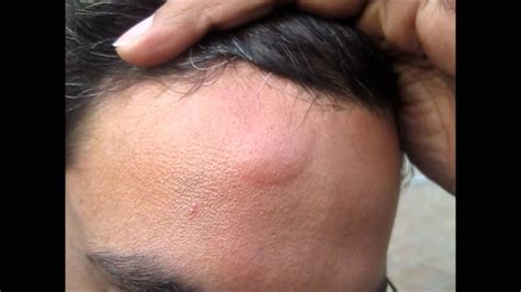 Bump On Forehead 7 Causes And Treatment Rezfoods Resep Masakan