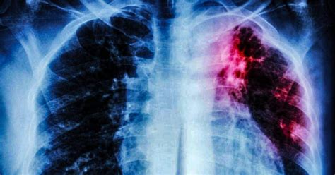 Asbestosis y Tuberculosis Radiografía y Datos