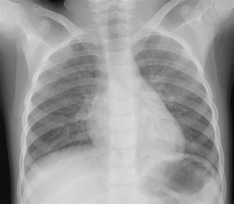 联合医院再多六人确诊 病格水龙头样本检出病毒 截至12月28日零时零分，香港新增61宗 #中共病毒 （武汉肺炎）确诊个案，60宗属本地感染，其中19宗源头不. こどもの病気・おとなの病気:ウイルス性肺炎(13)(14)