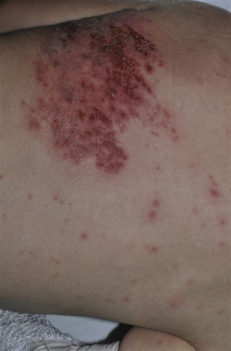 Figure 2 From Disseminated Pediatric Herpes Zoster Herpes Zóster