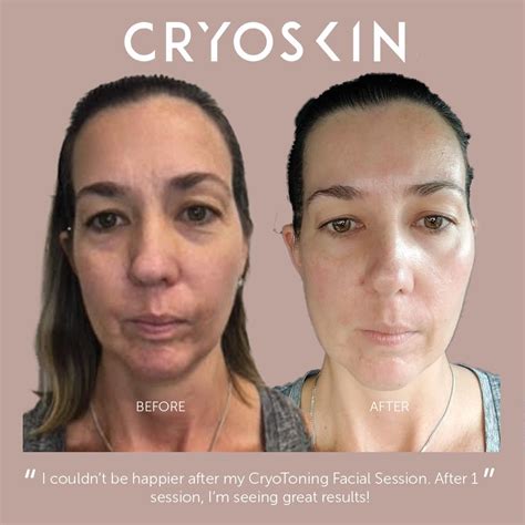 Cryoskin 30 Cryo Facials Holistic Therapies Love Wellness Improve